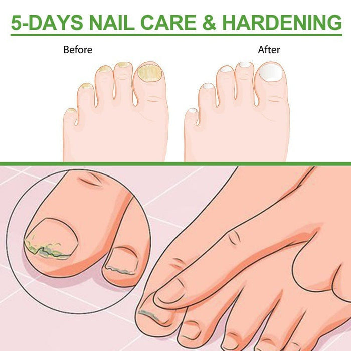 South Moon 5-day nail repair roller repairs onychomycosis, soft nails, bright nails, thickening nail care liquid